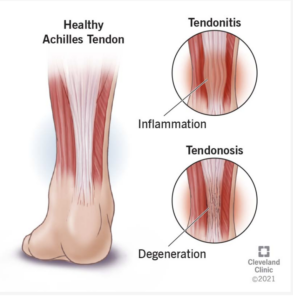 achilles achilles tendon diagram
