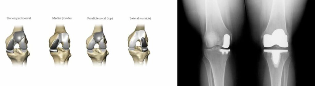 Rotator cuff tear surgery xrays