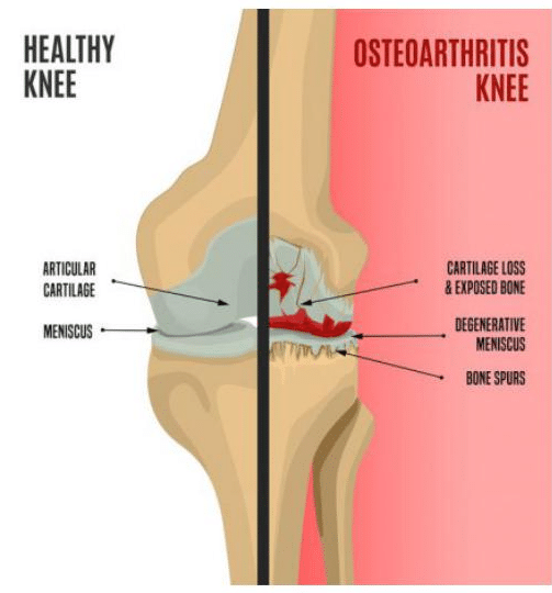 Osteoarthritis knee pain versus a healthy knee
