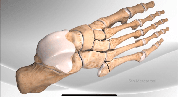 Ankle sprain diagram image