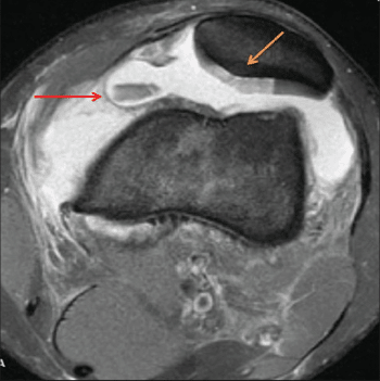 Kneecap xray image