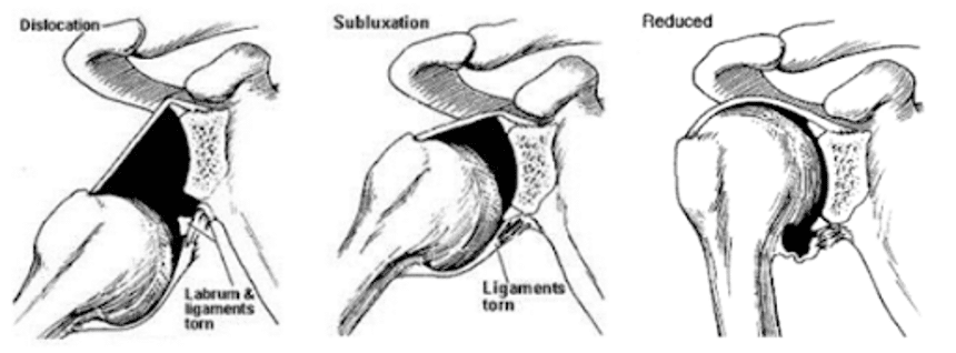 Labral tear 3D images
