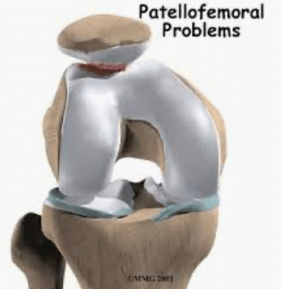 Patella femoral problems