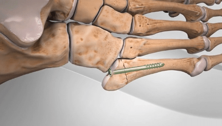 Stress fracture diagram image