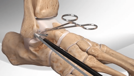 Ankle surgery image