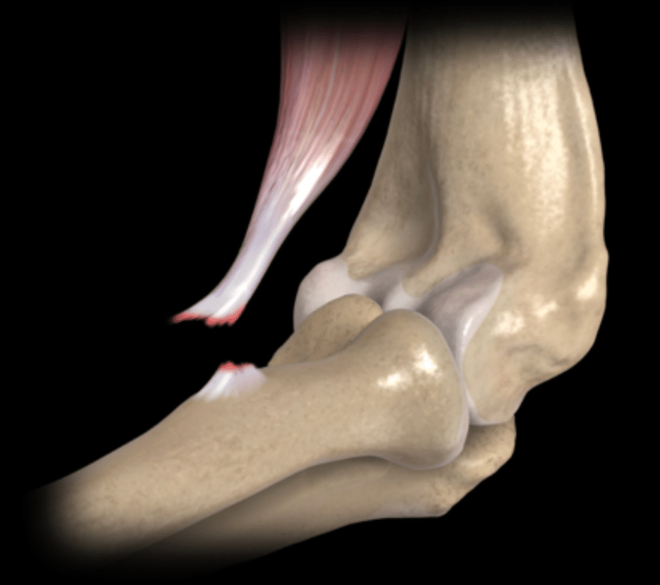 Bicep rupture image