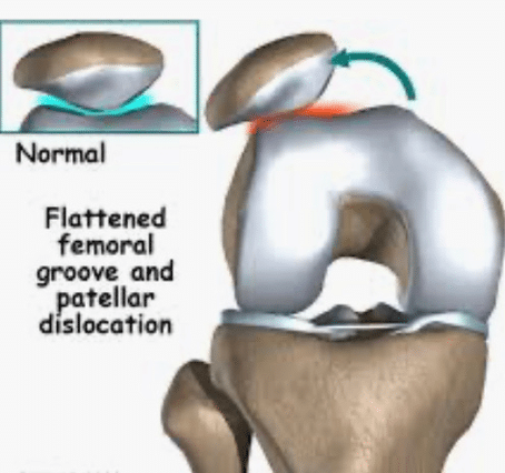 Patella femoral problems