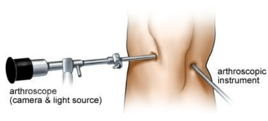 Meniscus surgery diagram