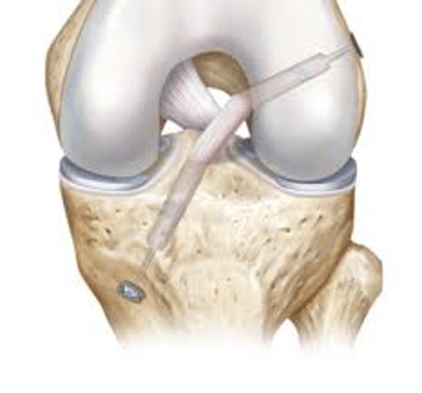 ACL treatment post-surgery