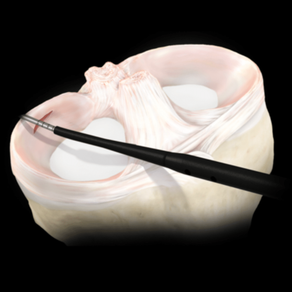 Meniscus surgery diagram