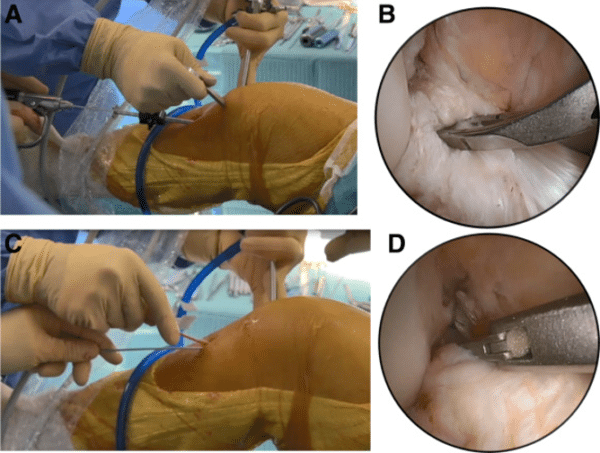 ACL Knee surgery images
