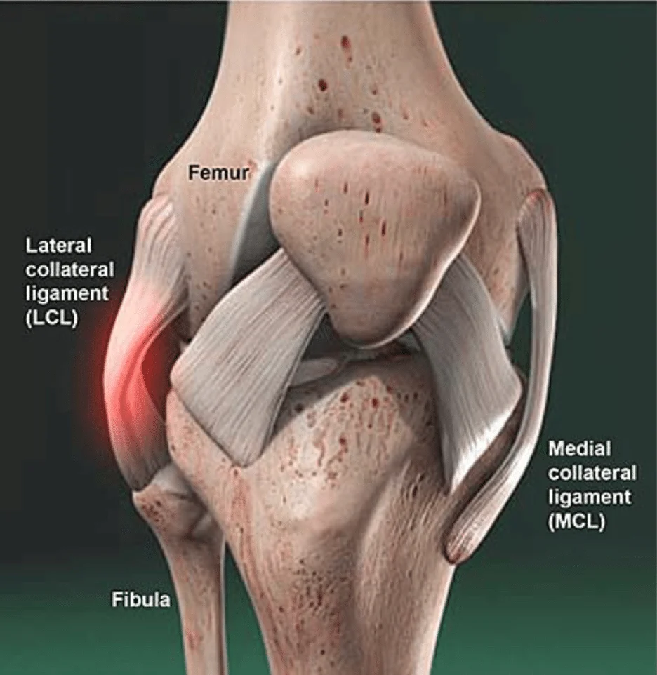 LCL Injury Diagnosis Diagram lcl injury diagnosis boise