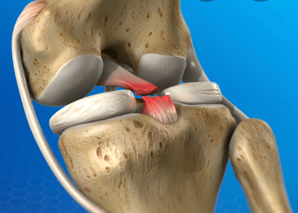 pcl injury treatment boise