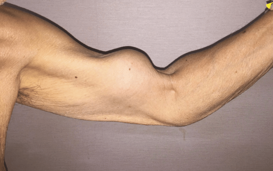proximal bicep rupture treatment boise