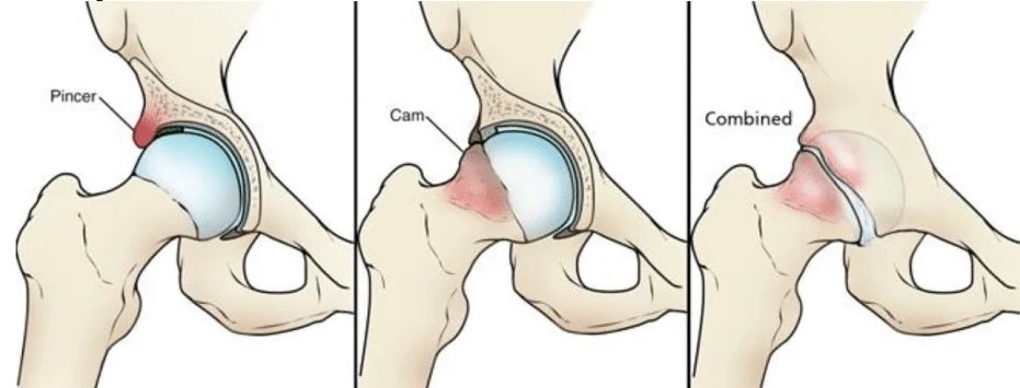 hip impingement treatment boise