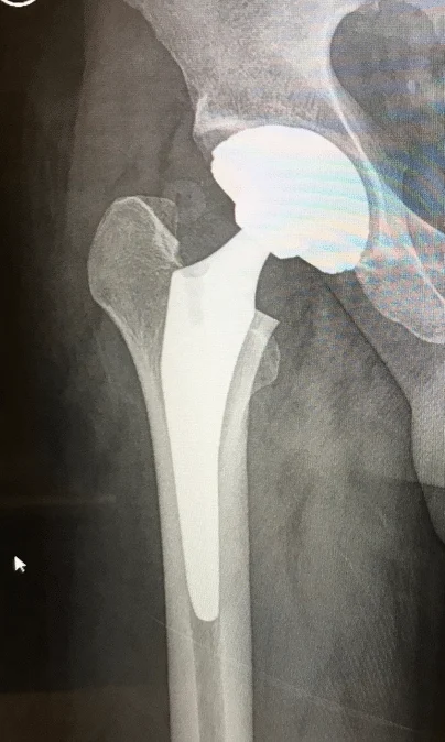Hip Replacement Surgery hip replacement surgery boise