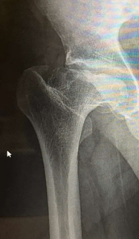 Hip Replacement X-Ray hip replacement surgery timeline boise