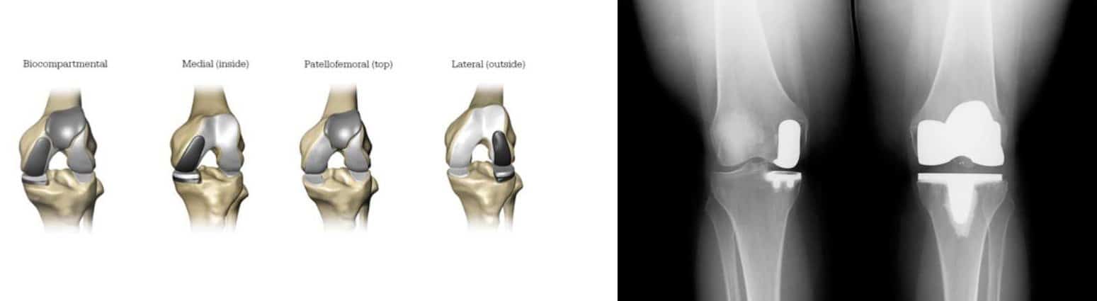 knee replacement x-ray boise