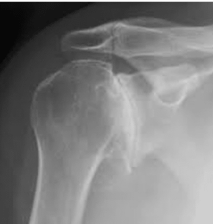 osteoarthritis causes boise