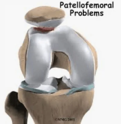 Patellafemoral Pain patellafemoral pain treatment boise