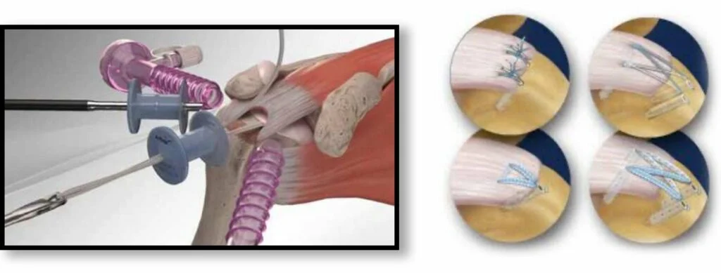 rotator cuff surgery boise