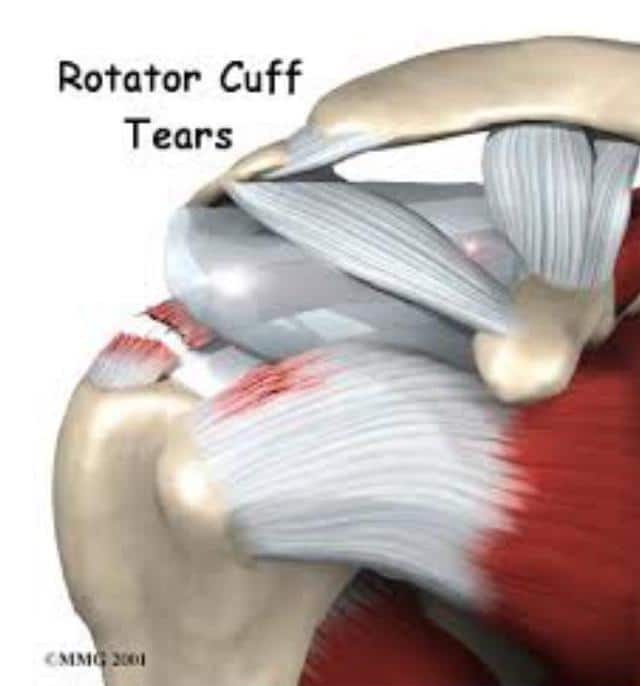 rotator cuff tear symptoms boise