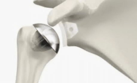 osteoarthritis surgery boise