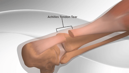 achilles tendon tear treatment boise