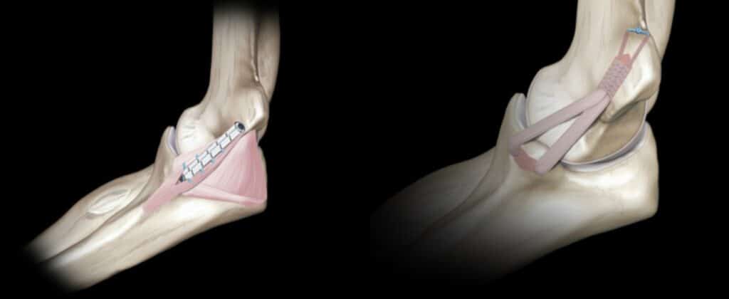 tommy john surgery recovery boise