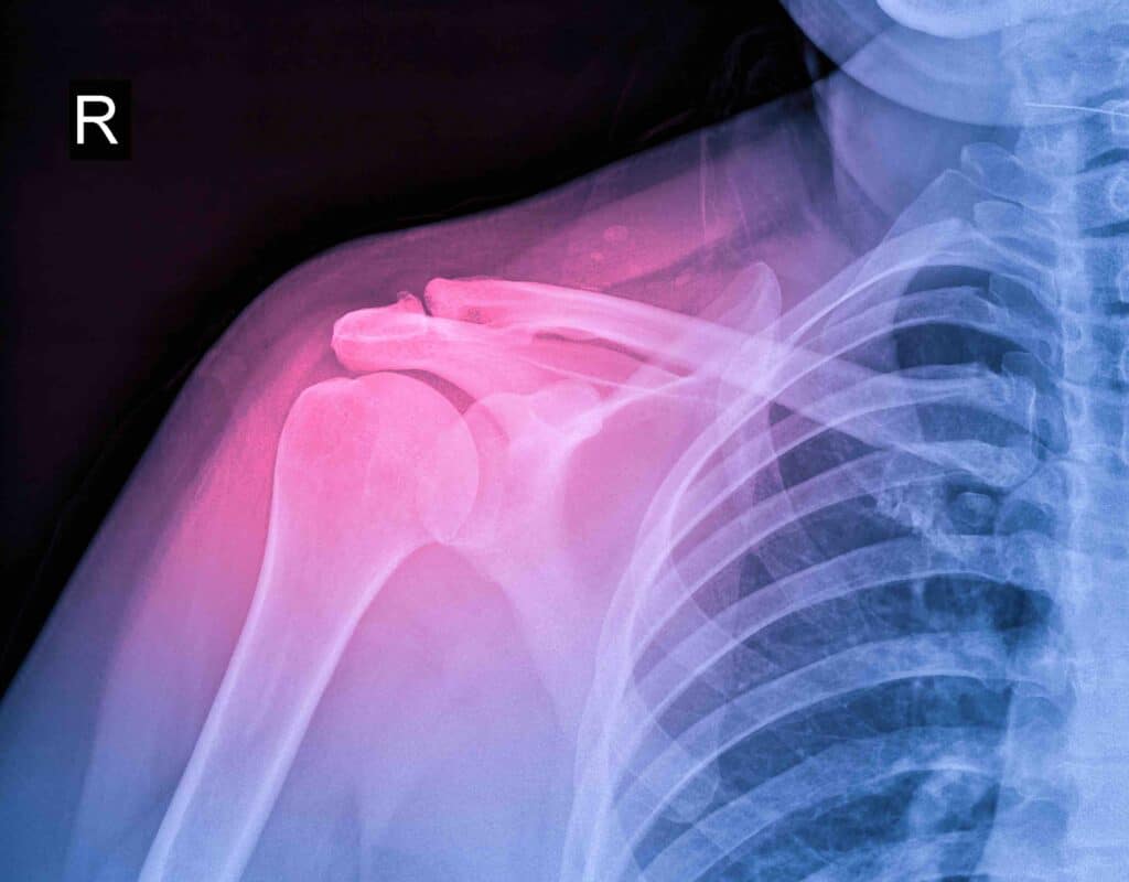 shoulder impingement diagnosis boise